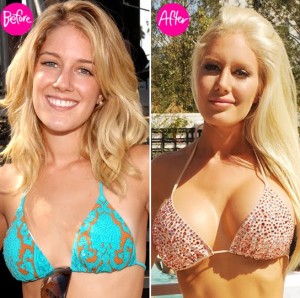 Heidi Montag Plastic Surgery Before And After - Plastic Surgery Talks