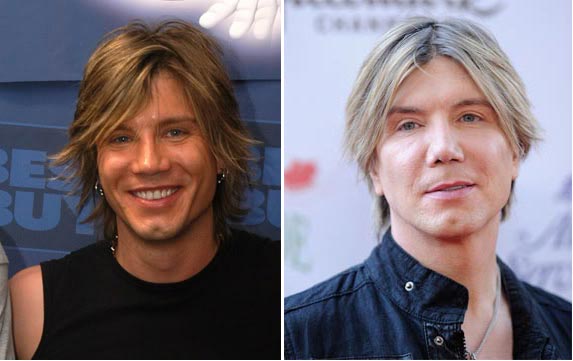 John Rzeznik Plastic Surgery Before & After - Plasticsurgerytalks.com