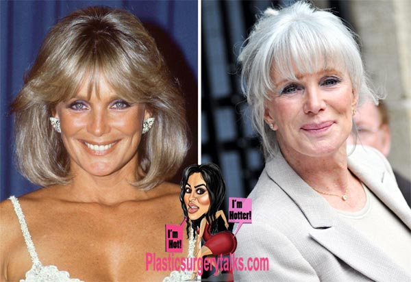 Linda Evans Plastic Surgery Before & After - Plastic Surgery Talks