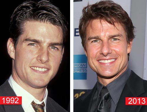 Tom Cruise Plastic Surgery Before & After