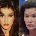 janice dickinson before and after plastic surgery