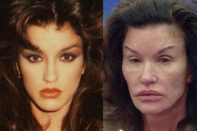 janice dickinson before and after plastic surgery