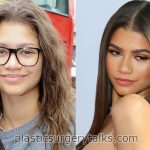 Zendaya Rhinoplasty