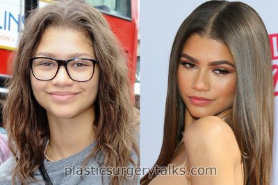 Zendaya Rhinoplasty