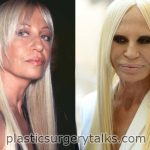 Donatella Versace Cosmetic Surgery