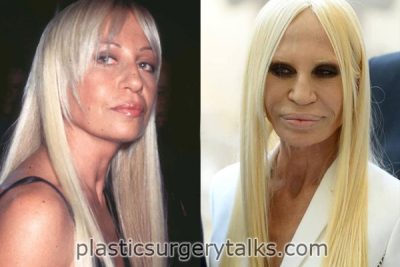 Donatella Versace Cosmetic Surgery
