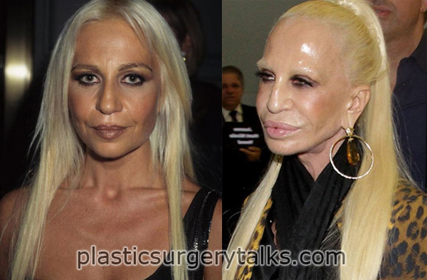 Donatella Versace Plastic Surgery