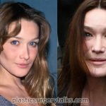 carla bruni cosmetic surgery