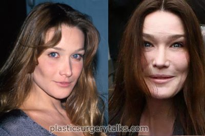 carla bruni cosmetic surgery