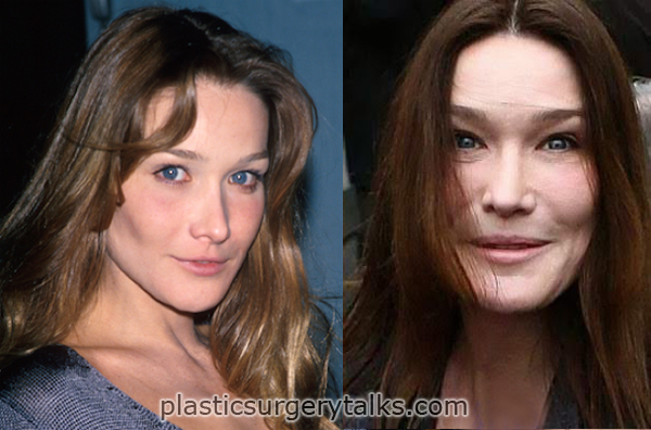 carla bruni cosmetic surgery