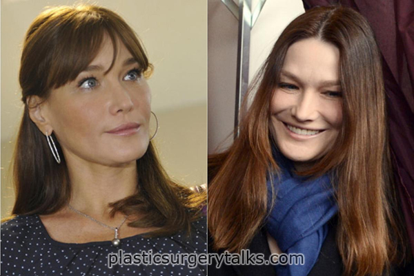 carla bruni plastic surgery