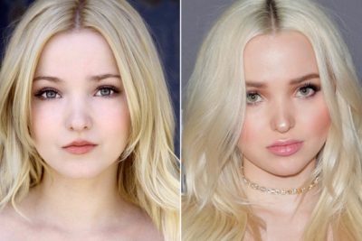 Dove Cameron Before and After Plastic Surgery