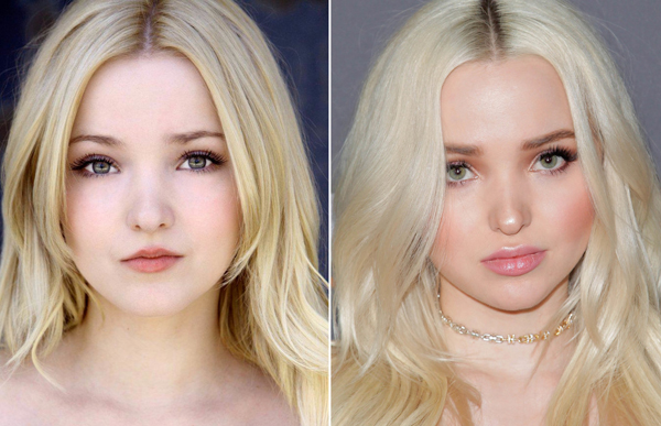 Dove Cameron Before and After Plastic Surgery