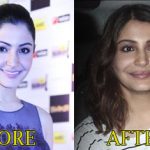 Anushka Sharma Lip Injection