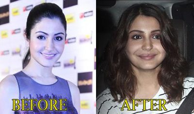 Anushka Sharma Lip Injection