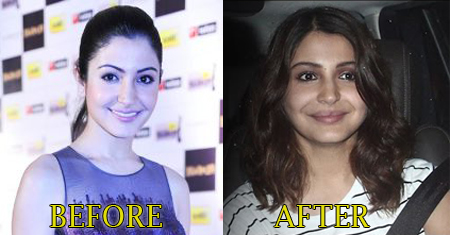 Anushka Sharma Lip Injection