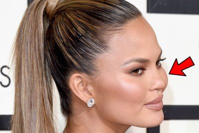 Chrissy Teigen Augmented Cheeks