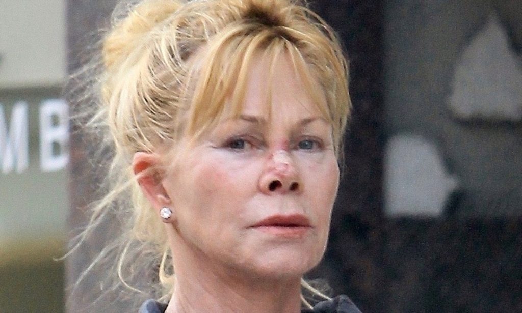 Melanie Griffith Plastic Surgery Procedures