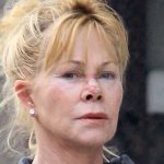 Melanie Griffith Plastic Surgery Procedures