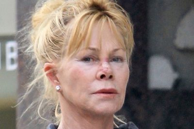 Melanie Griffith Plastic Surgery Procedures