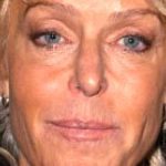 Farrah Fawcett Eyelid Surgery, Facelift, and Neck Lift